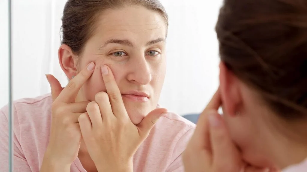 Acné de la ménopause sur le visage d'une femme mature